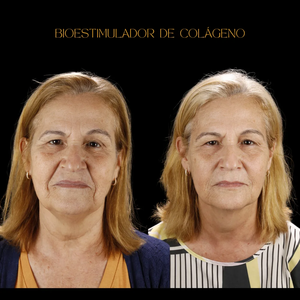 Antes e depois de bioestimulador de colágeno