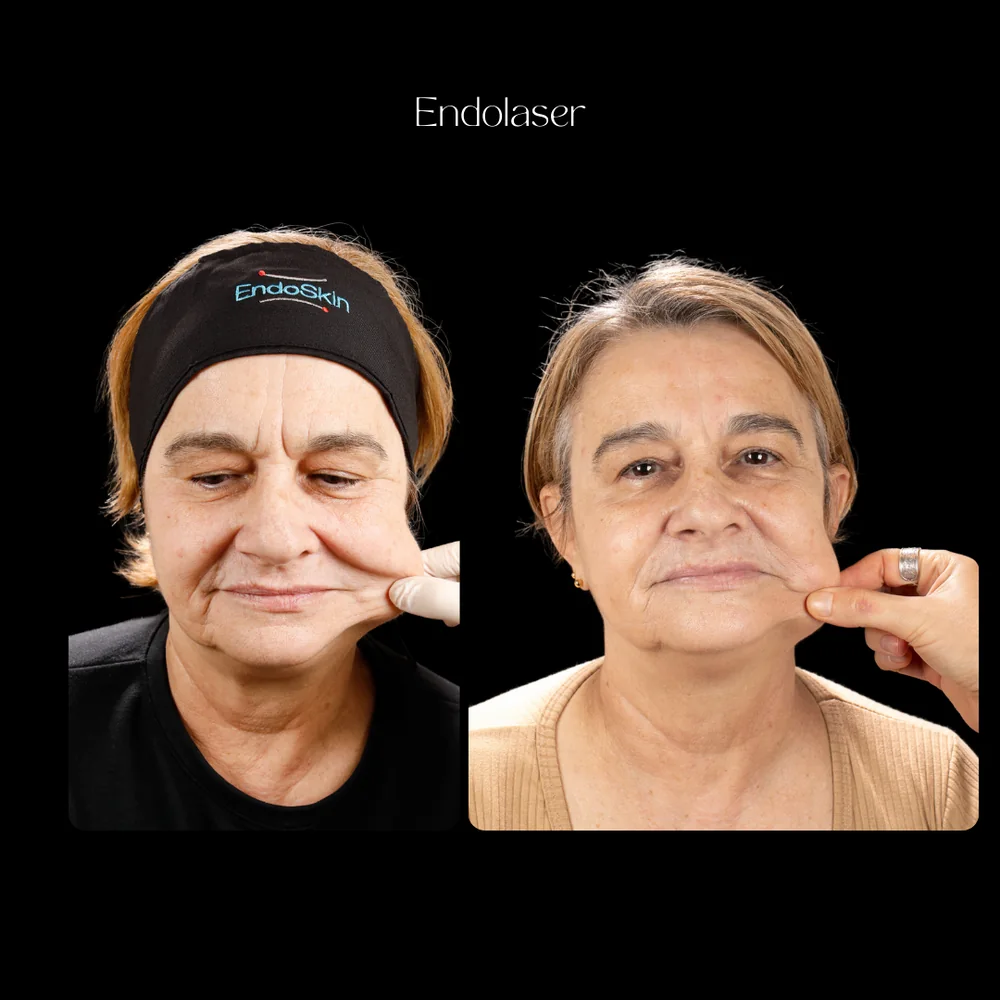 Antes e depois de tratamento Endolaser no rosto