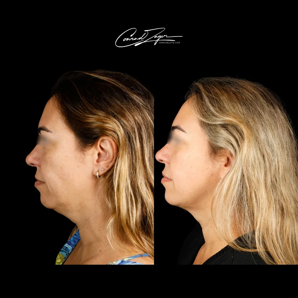 Antes e depois de tratamento de papada, perfil